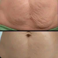 لیفت،فرم‌دهی‌بدن‌ورفع‌سلولیت(ترکیب‌هایفو وکویتیشن)