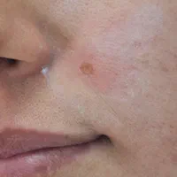 برداشتن انواع خال گوشتی و زگیل ومیکرونیدلینگ|خدمات آرایشگری و زیبایی|قم, انصار‌الحسین|دیوار