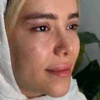 بلفارو لیفت پلک و چشم