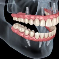 جشنواره ایمپلنت دیجیتال در شیراز|خدمات آرایشگری و زیبایی|جهرم, |دیوار