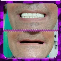 ساخت دندان مصنوعی باکیفیت وضمانت|خدمات آرایشگری و زیبایی|نهاوند, |دیوار