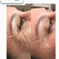 مدل فیلر و بوتاکس|خدمات آرایشگری و زیبایی|تهران, ائمه اطهار|دیوار