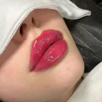 تزریق ژل و بوتاکس در کلینیک زیبایی