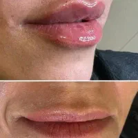 مدل برای فیلر لب و بوتاکس|خدمات آرایشگری و زیبایی|کرمانشاه, |دیوار