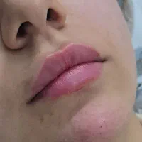 تزریق بوتاکس فیلر ژل لب آنزیم لب توسط پزشک