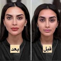 تزریق ژل و بوتاکس طراحی چهره برای زیبایی‌خاص|خدمات آرایشگری و زیبایی|تهران, شادمان|دیوار
