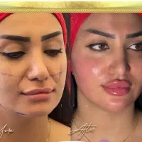 آموزش فیشیال،ژل بوتاکس برای آقاها،خانم هفده شهریور