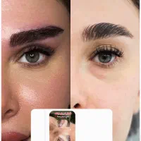 بلفارو توسط پزشک (۸۹۰۰) کاشت ابرو ۱۴ غبغب ۸تومن
