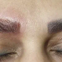 پاک کردن تتو(ریموو تتو)