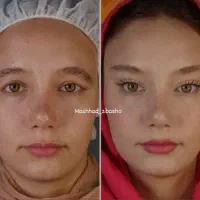 عمل بینی لیپو ساکشن ابدو غبغب بلفارو لیفت سانترال