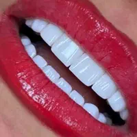 لمینت.روکش.دندانپزشکی عصبکشی کامپوزیت