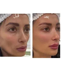 پاکسازی و جوانسازی پوست و صورت .مزو .بوتاکس چربی|خدمات آرایشگری و زیبایی|اسلام‌شهر, شهرک مصطفی خمینی|دیوار