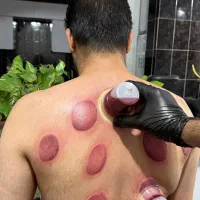 حجامت حرفه ای در کلینیک