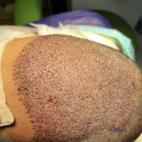 کاشت مو|خدمات آرایشگری و زیبایی|ایلام, |دیوار