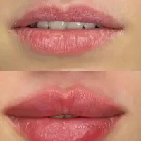 تخفیفات ژل وبوتاکس برای خانمهاواقایون