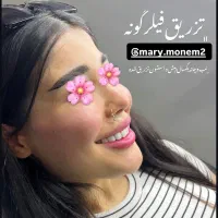 تزریق فیلر ب نواحی صورت همراه با اشانتیون