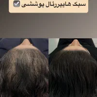 میکرواسکالپ اسکراپ کاشتمو درمجموعه زیبانو|خدمات آرایشگری و زیبایی|مشهد, گوهرشاد|دیوار