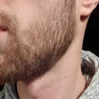 کاشت ریش نرو چون