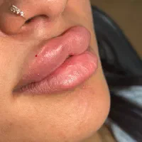 خدمات ژل و بوتاکس