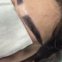 کاشت مو ابرو ریش مزوتراپی و پی آرپی