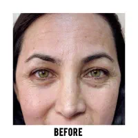 لیفت. بلفا. ساکشن