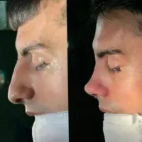 جراحی زیبایی بینی با۲۹میلیون