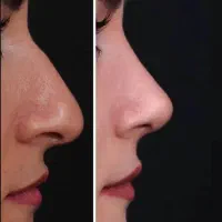 عمل زیبایی بینی|خدمات آرایشگری و زیبایی|حمیدیه, |دیوار