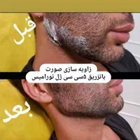 تزریق ژل و بوتاکس پک مادلینگ، مزونیدلینگ ۵۰٪تخفیف|خدمات آرایشگری و زیبایی|پردیس, فاز ۱|دیوار