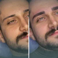 تزریق فیلر لب روسی