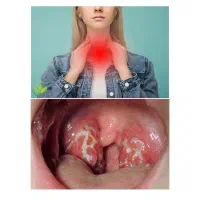 خلط پشت حلق