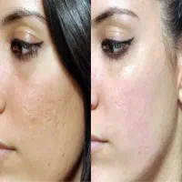پی ار پی،جشنواره سلول بنیادی جفت جنین،ترمیم زخم|خدمات آرایشگری و زیبایی|قم, دورشهر|دیوار