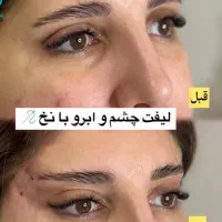 مطب پزشک.ژل وبوتاکس.لیفت بانخ.فیلربینی ژل آلت|خدمات آرایشگری و زیبایی|قم, دورشهر|دیوار