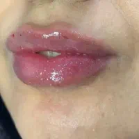 خدمات ژل وبوتاکس