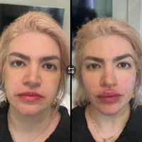 بوتاکس پیشانی /جوانسازی بیکینی بانوان /ژل صورت ۷۵۰