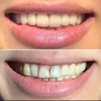 دندانپزشکی/لمینت/روکش|خدمات آرایشگری و زیبایی|تهران, فلسطین (میدان انقلاب)|دیوار