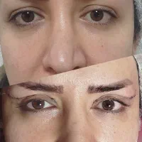 جراحی بلفارو پلاستی ساکشن غبغب بوکال فت سانترال .|خدمات آرایشگری و زیبایی|کرج, فاز ۳ مهرشهر|دیوار