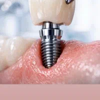 ایمپلنت دیجیتال ، متخصص اطفال ،ارتودنسی،