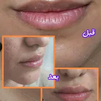 آنزیم ژل فیلر مزو بوتاکس فیشیال لابیا تنگی هودکتوم|خدمات آرایشگری و زیبایی|مشهد, آزادشهر|دیوار