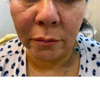 باجدیدترین تکنولوژی لیزری با پیری بجنگید