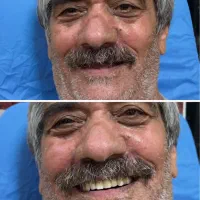 دندانسازی پروتز دندان با پرداخت قسطی