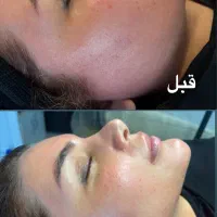 لیفت و جوانسازی پوست شما در کلینیک نچرال