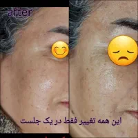 مزونیدلینگ،پوست کره‌ای(تاعیدپوستتوآیینه کن)