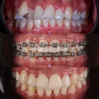 *ارتودنسی اقساط بدون چک* ایمپلنت کامپوزیت لمینت