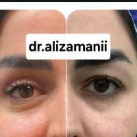 بلفاروپلاستی کاشت ابرو کاشت مو تخفیف|خدمات آرایشگری و زیبایی|تهران, دریاچه شهدای خلیج فارس|دیوار