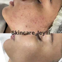 پاکسازی و فیشال تخصصی صورت و بدن ، اسکالپ