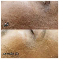 فیشال پاکسازی پوست آقایان فیشیال تخصصی کلینیک قم|خدمات آرایشگری و زیبایی|قم, دورشهر|دیوار