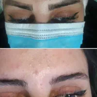 ریموو تتو با لیزر کیوسوییچ|خدمات آرایشگری و زیبایی|خرم‌آباد, |دیوار