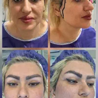 اندولیفت جراحی لیفت شقیقه گونه ابروچشم مینی بلفارو|خدمات زیبایی و سلامت|تهران, بلوار کشاورز|دیوار