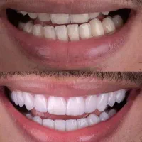 دندانپزشکی زیبایی|خدمات آرایشگری و زیبایی|تهران, ازگل|دیوار
