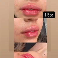 ژل. مزو ژل. جوانساز. بوتاکس